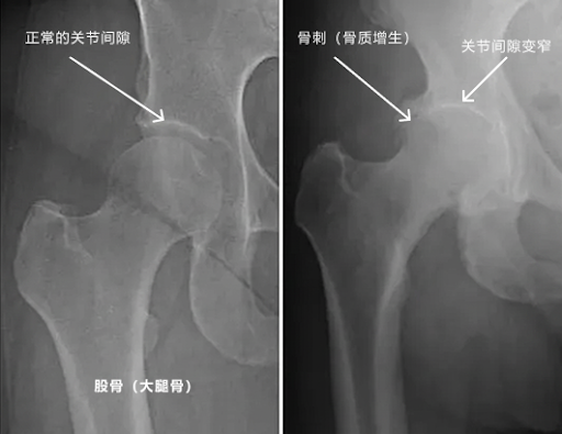 骨刺 X 光示意图:正常骨骼对比骨刺增生,适用于骨刺治疗参考